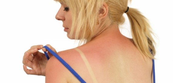 солнечные ожоги